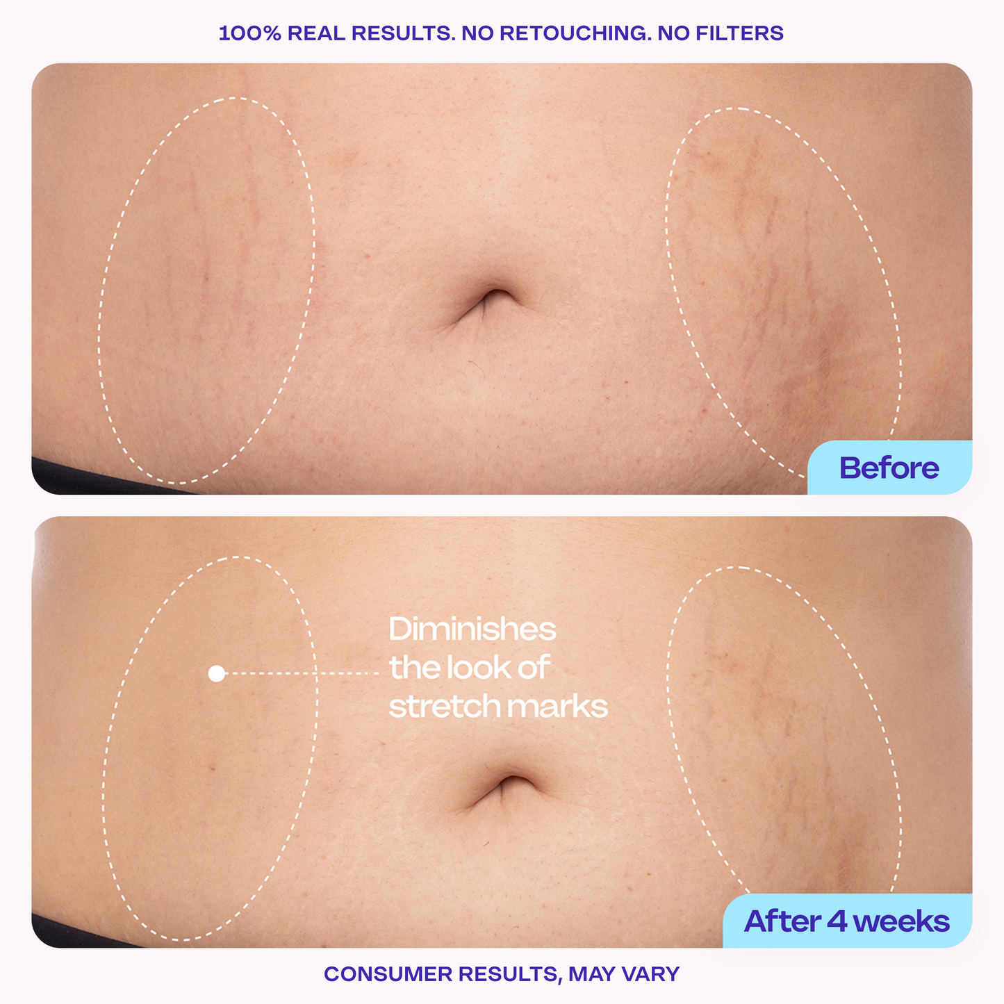 Final 3 hours 70% off π₯ New! Tighten & Smooth Belly Firming Cream