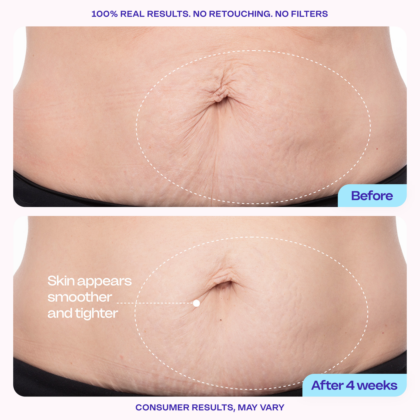 Final 3 hours 70% off π₯ New! Tighten & Smooth Belly Firming Cream